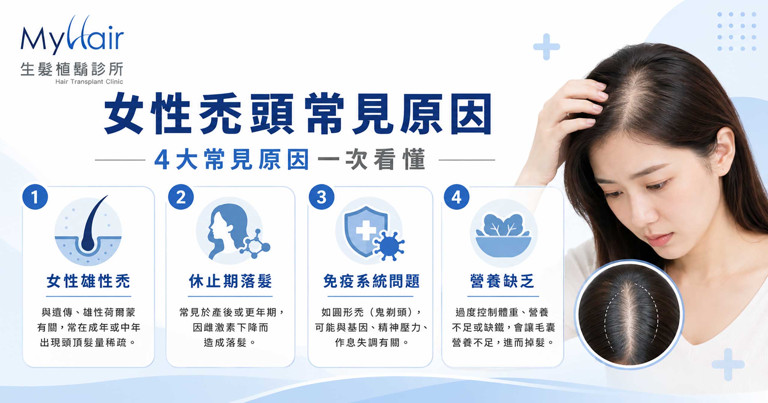 Female pattern hairloss