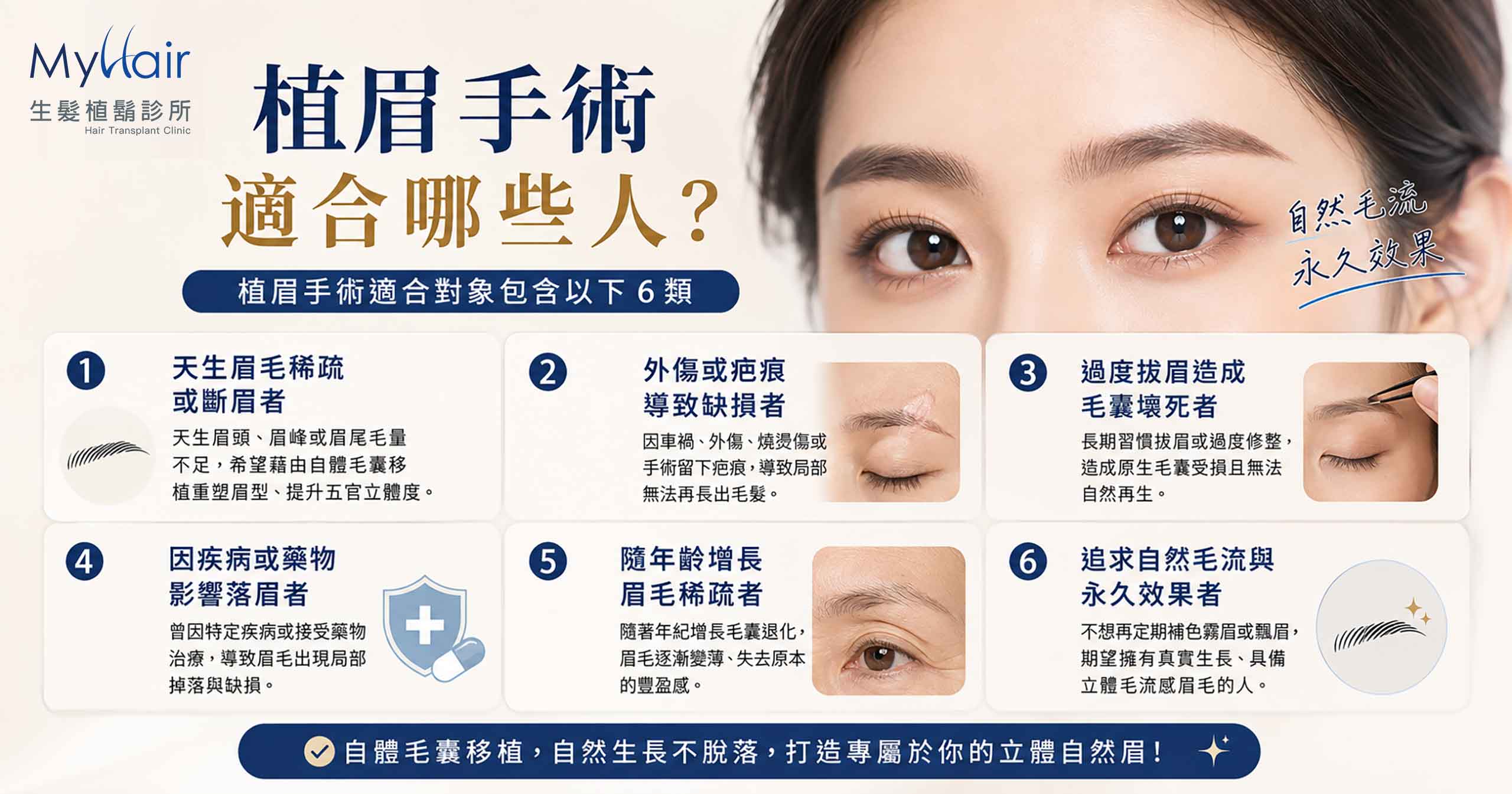 Post eyebrowtransplant