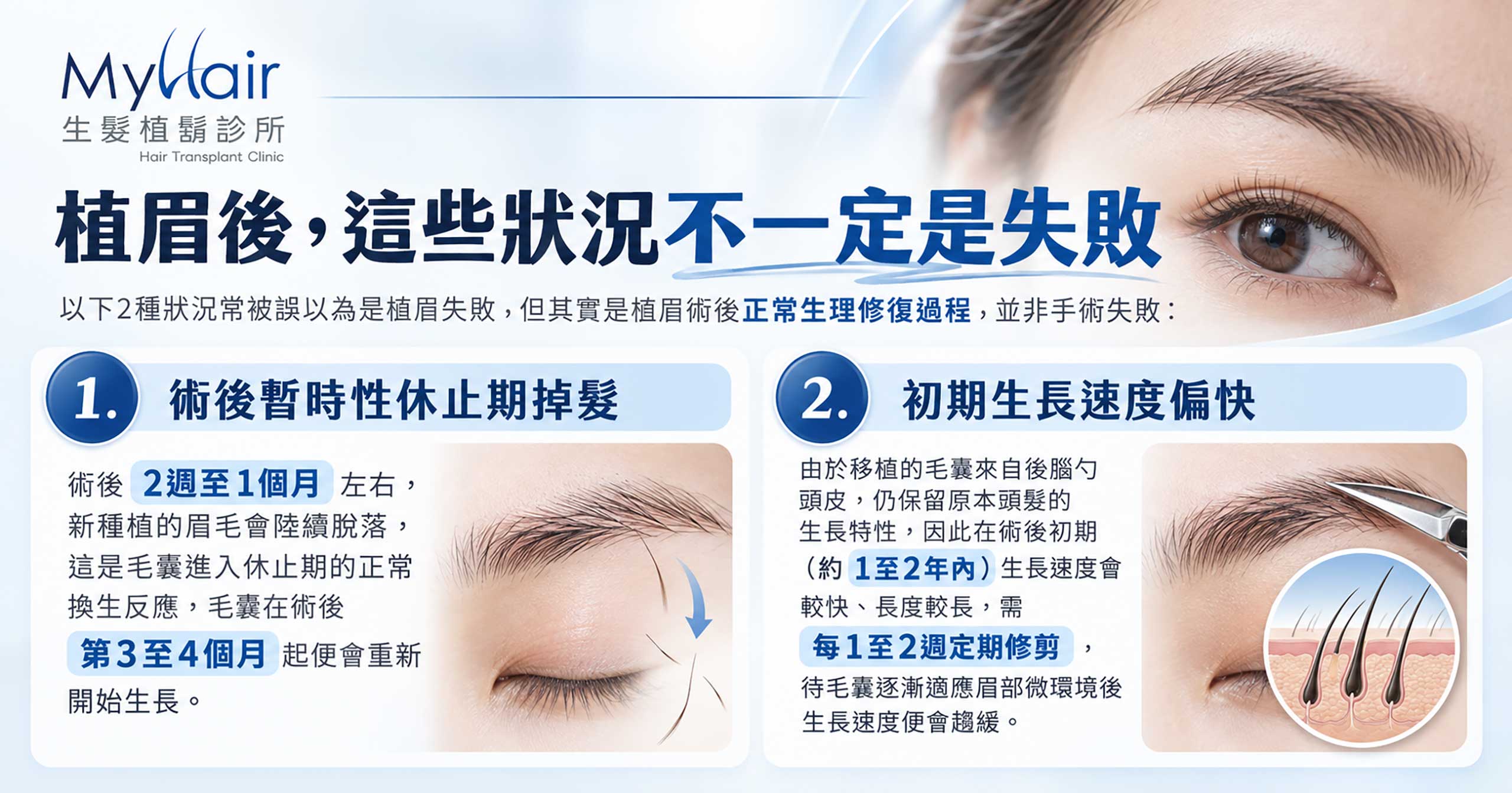 Post eyebrowtransplant 6a
