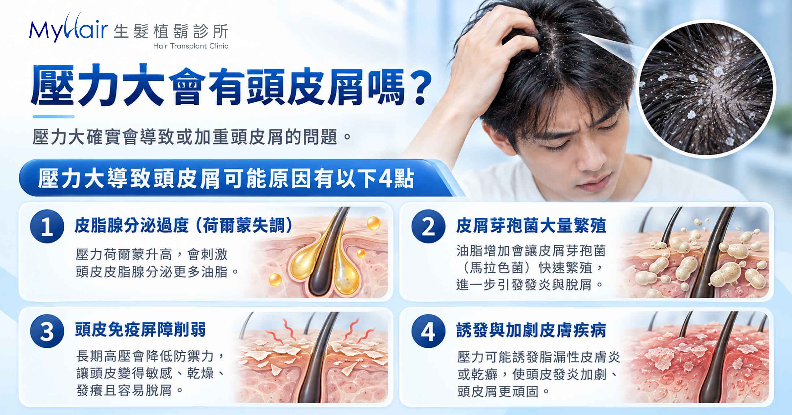 Stress related hair loss