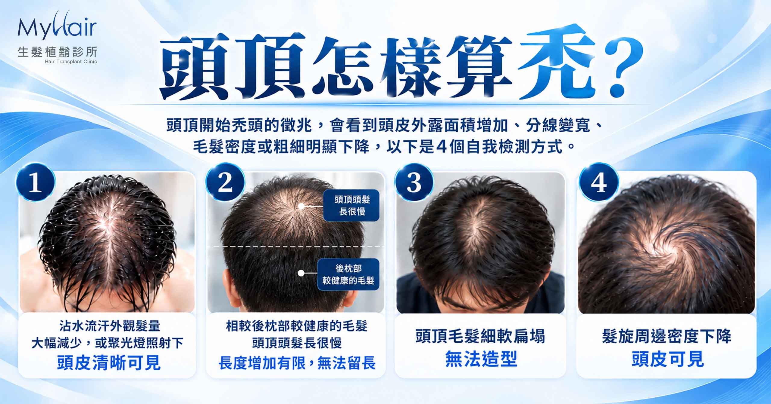 Balding